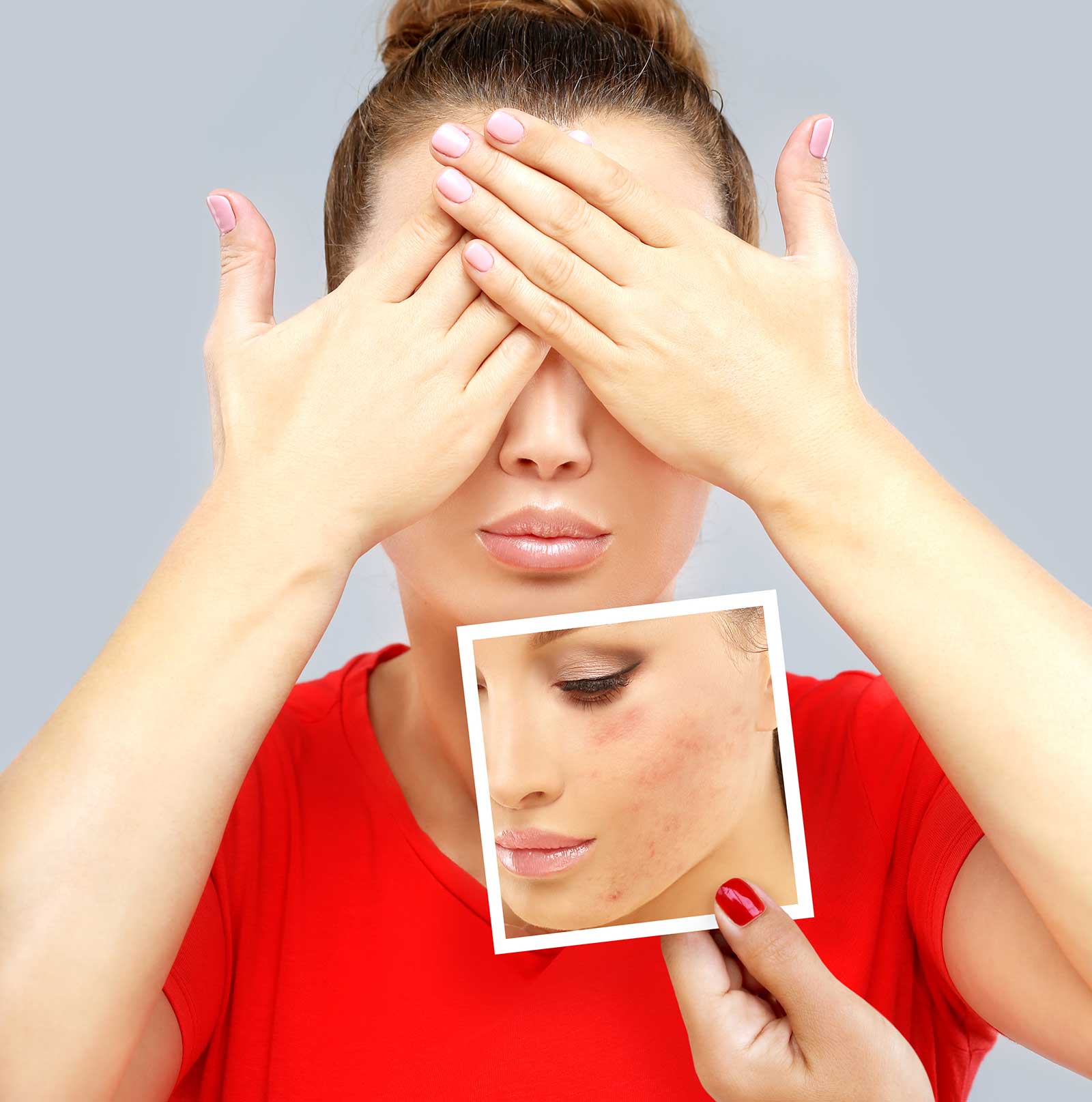 A photo of a woman covering her eyes as another photo is held in front of her, showing her face with acne scarring. The photo represents acne scarring, one of the conditions treated at The Women's Clinic