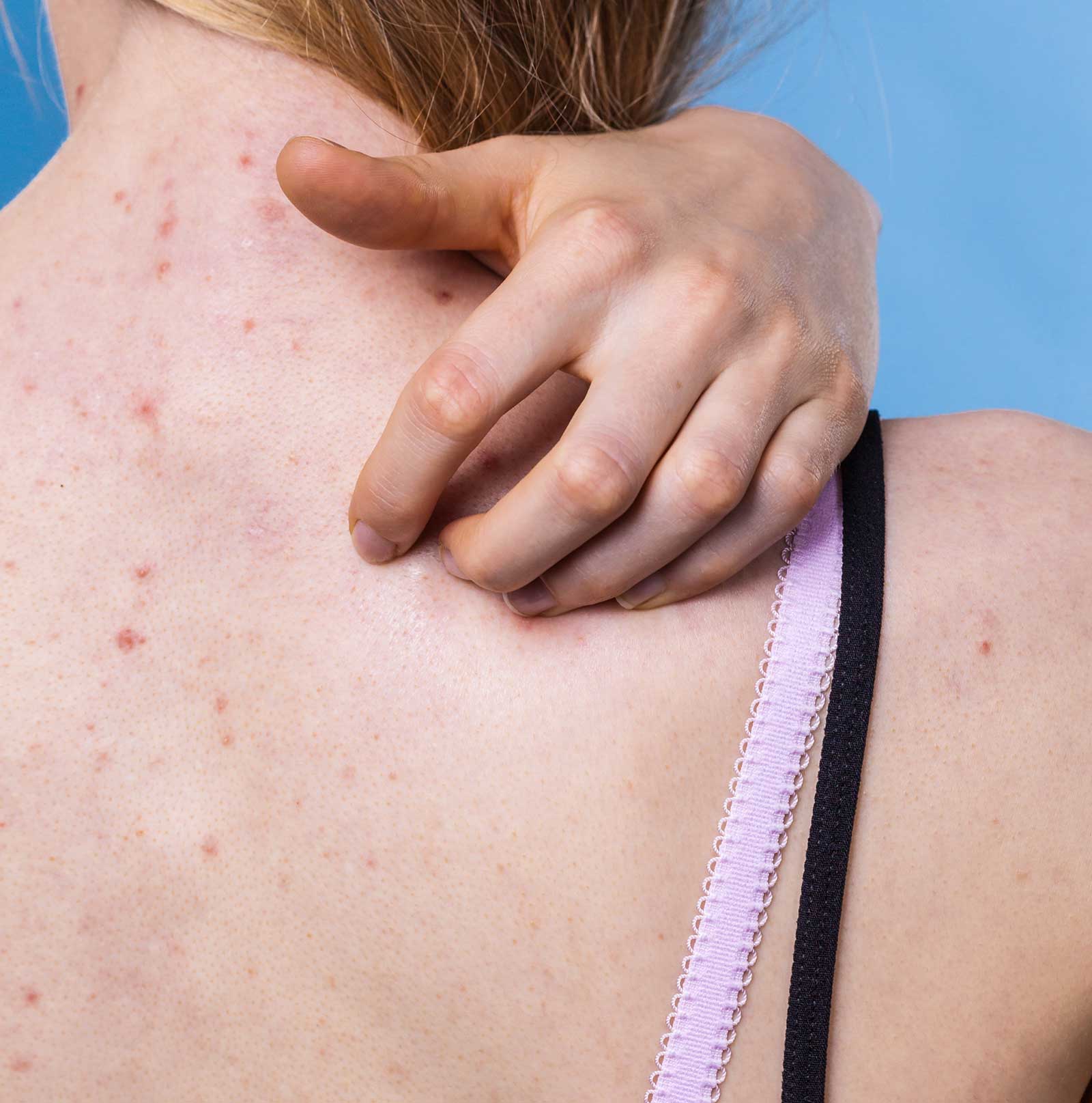 A photo of a woman scratching her back, the skin of which appear irritated. The photo represents seborrheic hyperplasia one of the acne and scarring-related conditions treated at The Women's Clinic