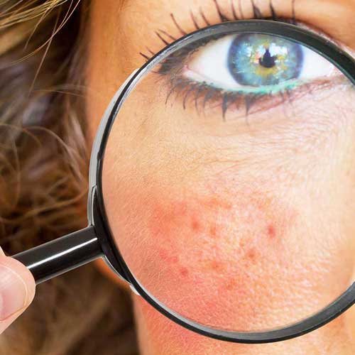 A close-up of a woman holding a magnifying glass to highlight the acne on her cheek. This page is for acne and acne scars, one of the skin conditions treated at The Women's Clinic